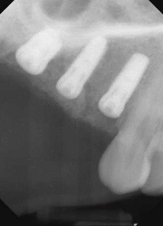 Dental implant radiograph