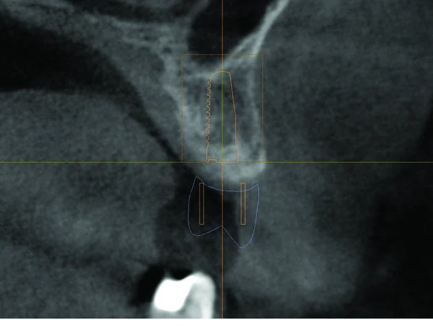 Dental implant planning radiograph